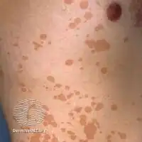 Pityriasis versicolor: dark well-defined marks