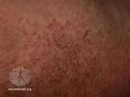 Pityriasis versicolor: reddish-brown