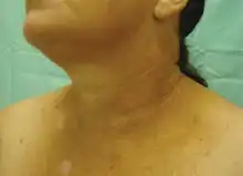 Poikiloderma of Civatte