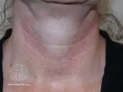 Poikiloderma of Civatte