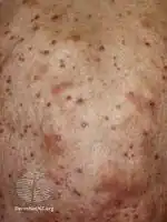 Primary cutaneous anaplastic large cell lymphoma