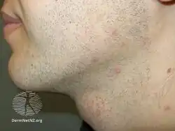 Pseudofolliculitis barbae