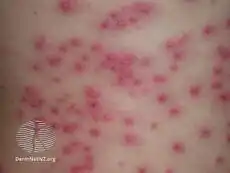 Pseudomonas folliculitis