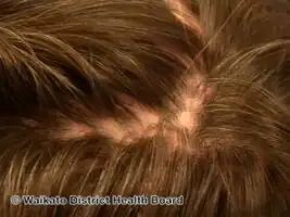 Pseudopelade of Brocq