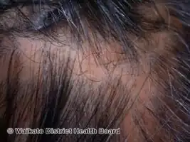 Pseudopelade of Brocq