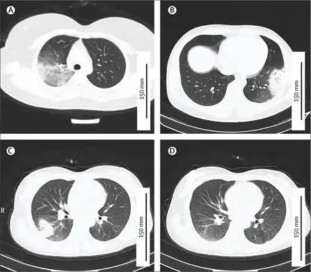 a-d)CTs of individual with Chlamydia psittaci infection