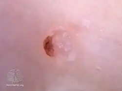 Rosettes seen in molluscum contagiosum