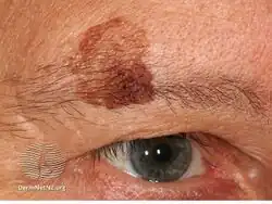 Seborrhoeic keratosis