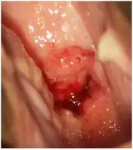 Severe cervicitis caused by schistosomiasis