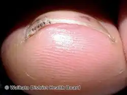 Splinter hemorrhage seen end on