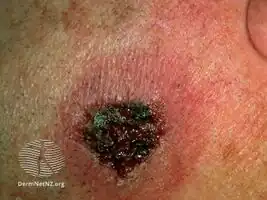 The following side effects can occur in the treated areas