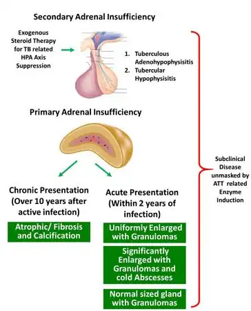 Mechanisms of adrenal insufficiency with tuberculosis.[24]