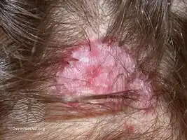Tufted folliculitis