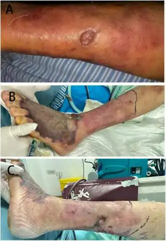 a-c)Wound and blister formation on left lower limb, from inner ankle to the entire dorsum of foot[5]
