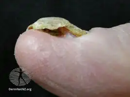 Yellow nail syndrome