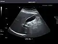 Gallbladder
