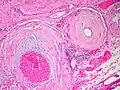 Amyloidosis, blood vessels, H&E