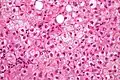 Ballooning degeneration. H&E stain.