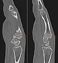 Carpal boss in CT.