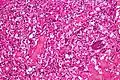 Micrograph of cerebellar hemangioblastoma. HPS stain.