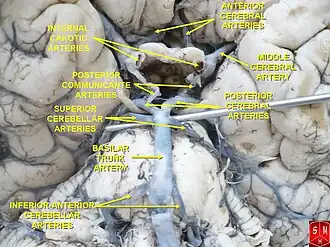 Circle of Willis