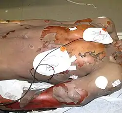 Crime scene photograph showing Rainey's right hand and what appears to be a bruise that could have been caused by him banging at the shower door.