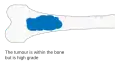 Stage 2A bone cancer