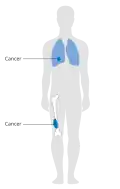 Stage 3 bone cancer