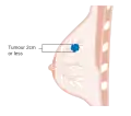 Stage T1 breast cancer