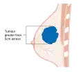 Stage T3 breast cancer