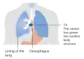 Stage T4 esophageal cancer