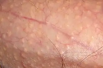 Small, raised, skin-colored lesions