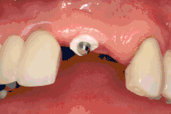 Abutment fracture