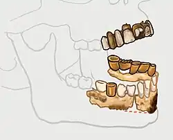 A maxillar bridge and mandibular fragment (color) against the rest of the jaws (transparent)