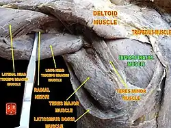 The infraspinatus shown on a cadaver, left shoulder, posterior view.