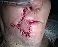 Suture intraoperatively