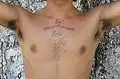 CS – Chest hair primarily on sternum and around the nipples