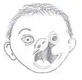 Maxillary dysplasia