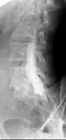 Conventional myelography in oblique projection. You can see the individual nerve root sheaths.