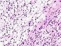Fig. 3 Lower-power micrograph of myxoid liposarcoma tumor