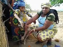 12-year-old child affected by polio