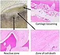 Pathology of avascular necrosis, with a photograph of a cross-section of the involved bone at top left. The reactive zone shows irregular trebaculae with empty lacunae, and fibrosis of the marrow space.