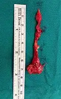 Pilonidal disease removed