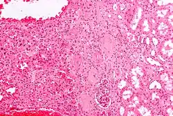 Micrograph of a renal oncocytoma. H&E stain.