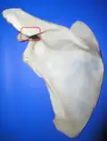 Left scapula. Posterior view. Acromional angle labeled in red.