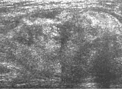Liposarcoma. A heterogeneous mass consists of an upper hyperechoic portion corresponds to lipomatous matrix and areas of hypoechogenicity corresponds to nonlipomatous component is seen.[citation needed]