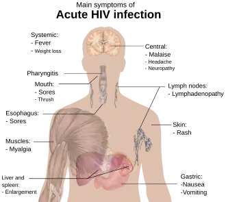 A diagram of a human torso labeled with the most common symptoms of an acute HIV infection