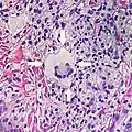Touton giant cell