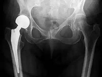 X-ray of the hips, with a right-sided hemiarthroplasty